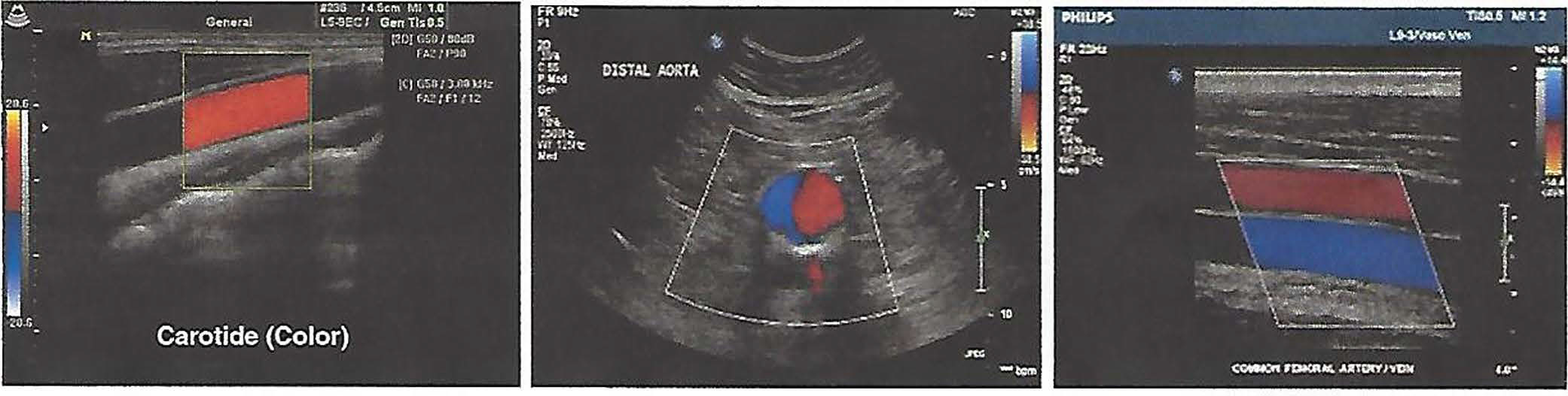 A picture of a vascular ultrasound
