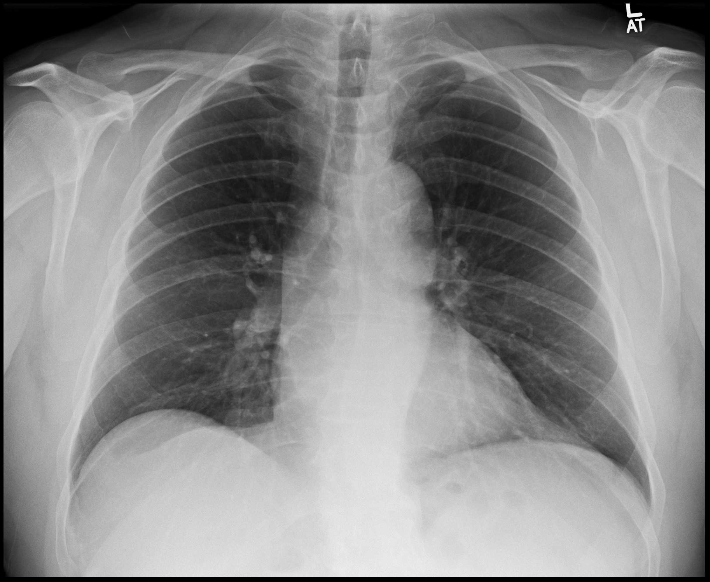 Chest x-ray