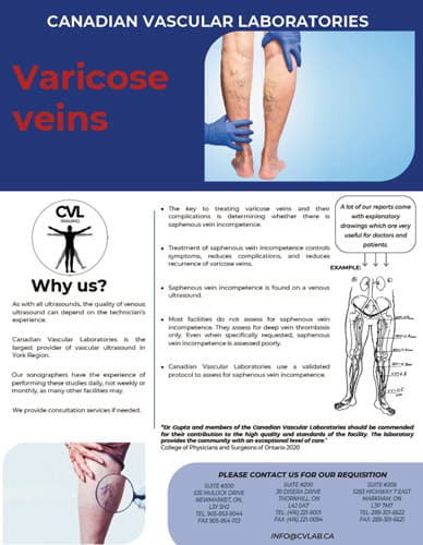 Varicose Veins